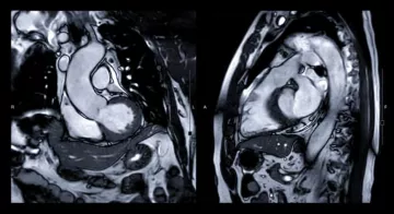 IRM cardiaque