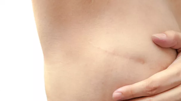 La chirurgie du cancer du sein et la reconstruction mammaire.