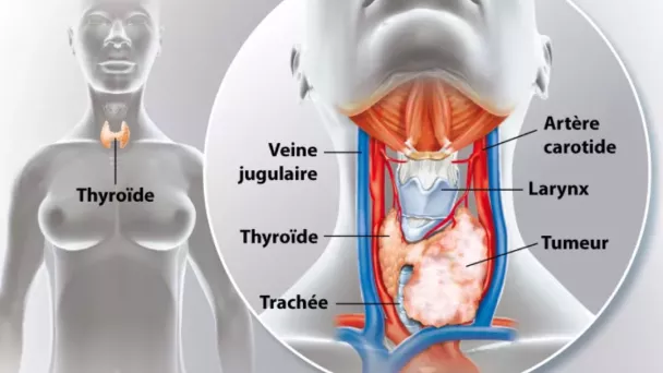 Cancer de la thyroïde : symptômes, causes et traitement
