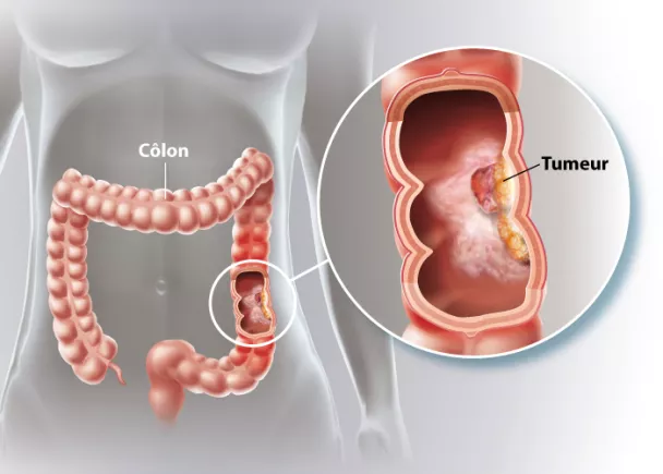 Tout ce que vous devez savoir sur le cancer du côlon