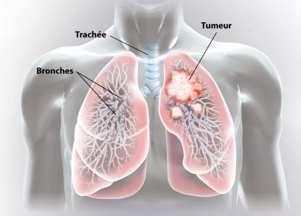 Cancer du poumon - Comment savoir si l'on a le cancer du poumon ...