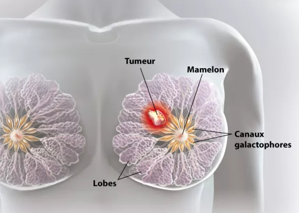 Cancer du sein, symptômes, diagnostic et traitements