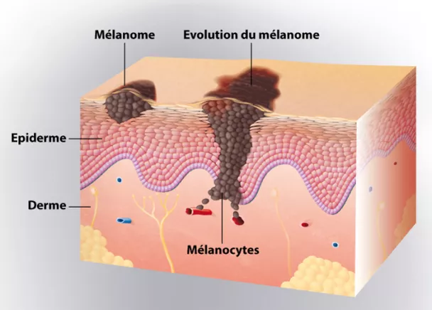 Mélanome | Ramsay Santé