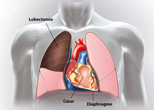 Lobectomie pulmonaire | Ramsay Santé
