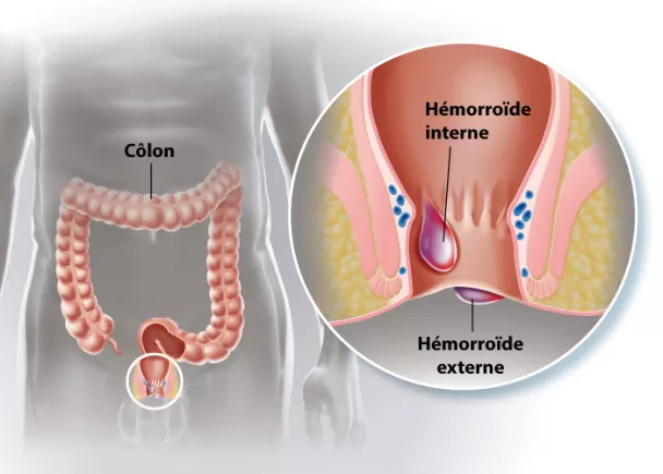 Le traitement - Embolisation des hémorroïdes