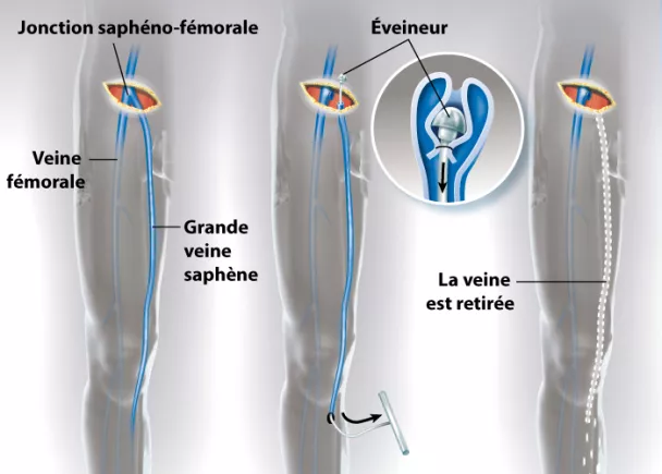 Opération des varices | Ramsay Santé