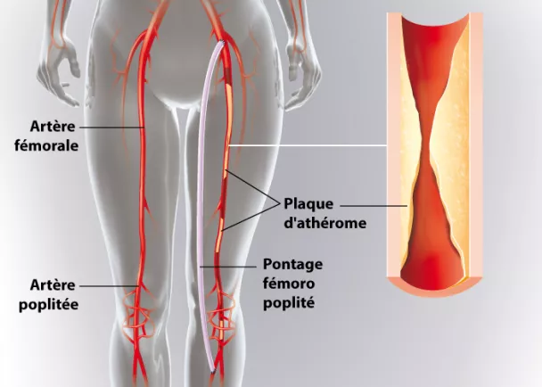 Pontage d'une artérite de jambe | Ramsay Santé