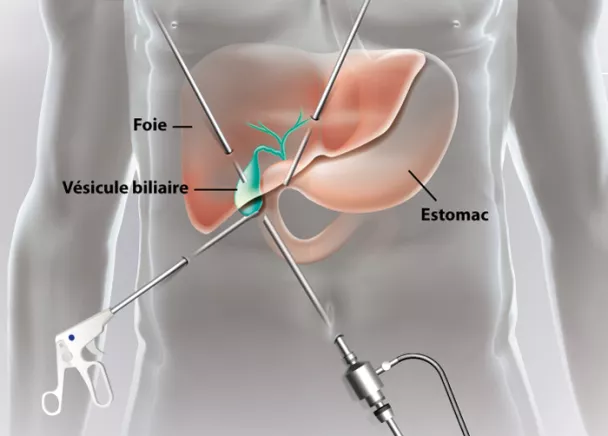 Ablation de la vésicule biliaire par chirurgie ouverte | Ramsay Santé