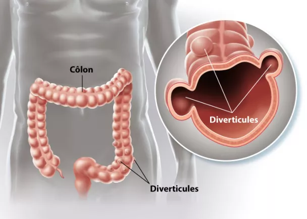 Diverticules du côlon - Colon diverticulaire | Ramsay Santé