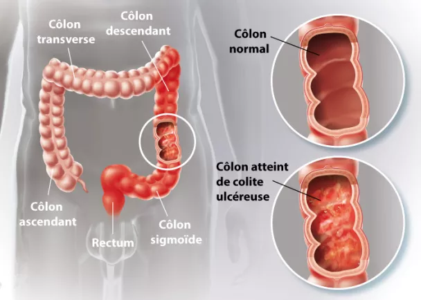 Rectocolite hémorragique - RCH symptômes | Ramsay Santé