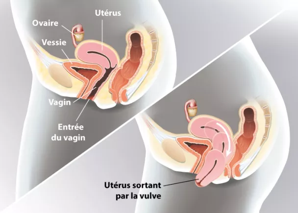 Prolapsus - Descente d'organes | Ramsay Santé