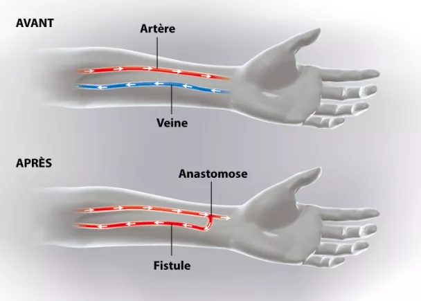 La fistule artério-veineuse pour hémodialyse | Ramsay Santé