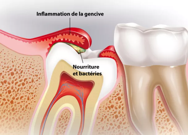 Extraction dentaire et dents de sagesse