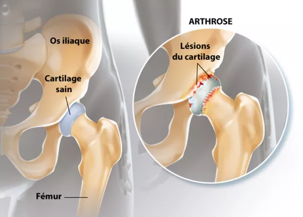 Arthrose de la hanche - Symptômes et traitement de l'arthrose ...