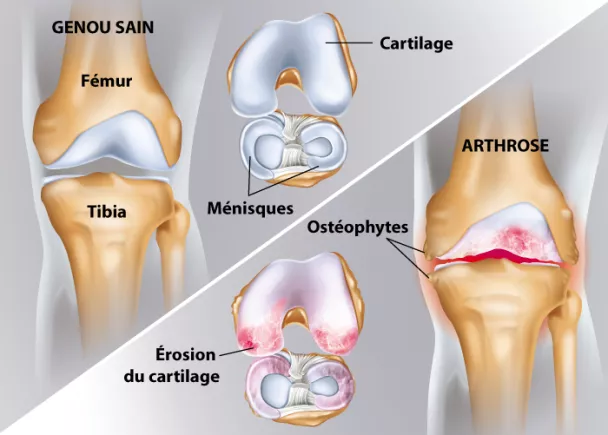 À propos de l'arthrose du genou