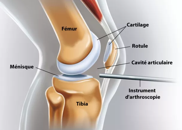 Arthroscopie du genou | Ramsay Santé