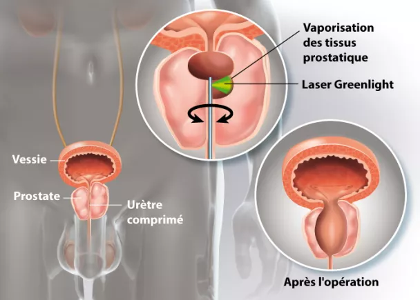 Résection de la prostate par laser | Ramsay Santé