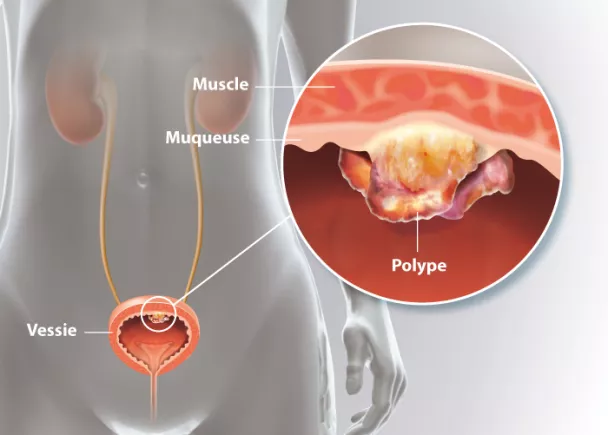 Polypes de la vessie | Ramsay Santé