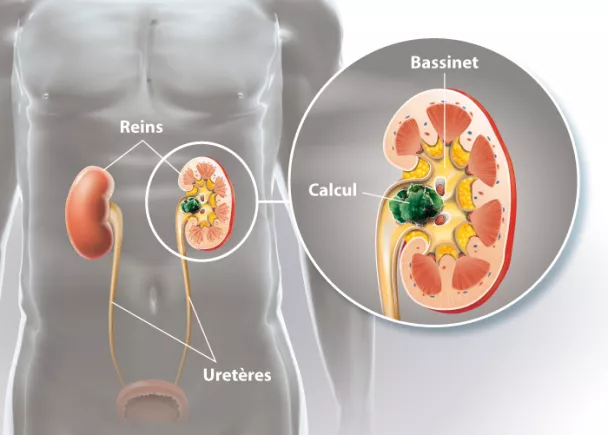 Calculs rénaux - Qu'est ce qu un calcul rénal | Ramsay Santé