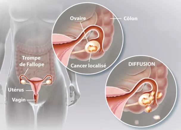 Cancer des ovaires - Kyste cancéreux à l'ovaire | Ramsay Santé