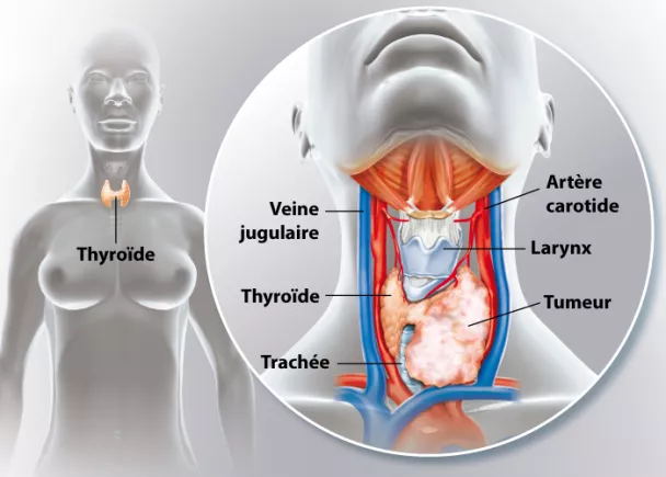 Cancer de la thyroïde : symptômes, causes et traitement