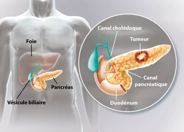 Cancer du pancréas, symptômes, diagnostic et traitements