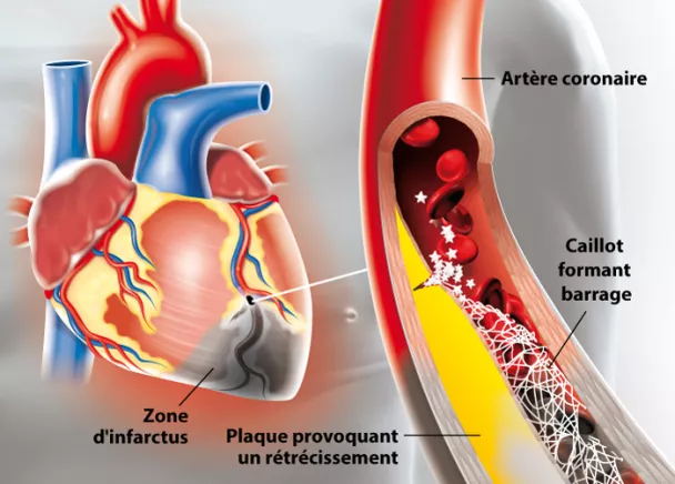 Infarctus du myocarde - Douleur dans la poitrine | Ramsay Santé