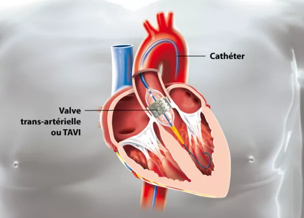 Implantation d'une valve aortique par voie percutanée (TAVI)