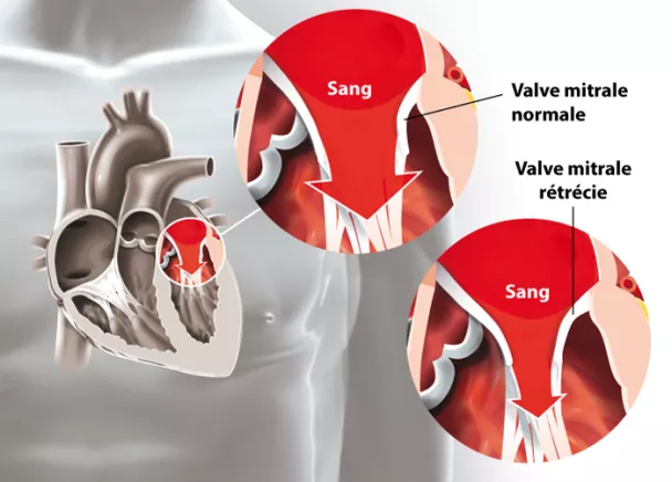 Valve cardiaque - Opération de la valve aortique