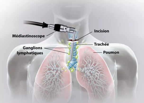 Mediastinoscopie - Ganglions médiastinaux | Ramsay Santé