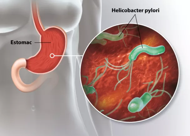 Infection à Helicobacter pylori : symptômes, traitement et ...
