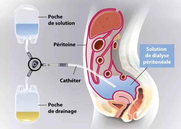 Dialyse péritonéale | Ramsay Santé