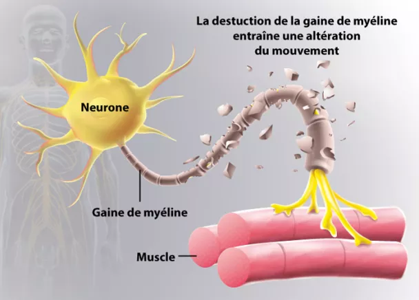 Sclérose en plaques, symptômes et traitement