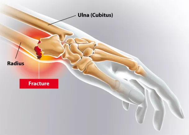 Fracture du poignet - Fracture de Pouteau-Colles | Ramsay Santé
