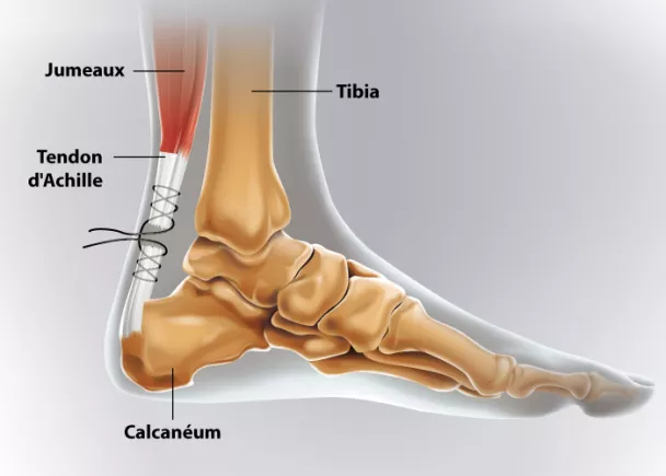 Rupture du tendon d'Achille | Ramsay Santé