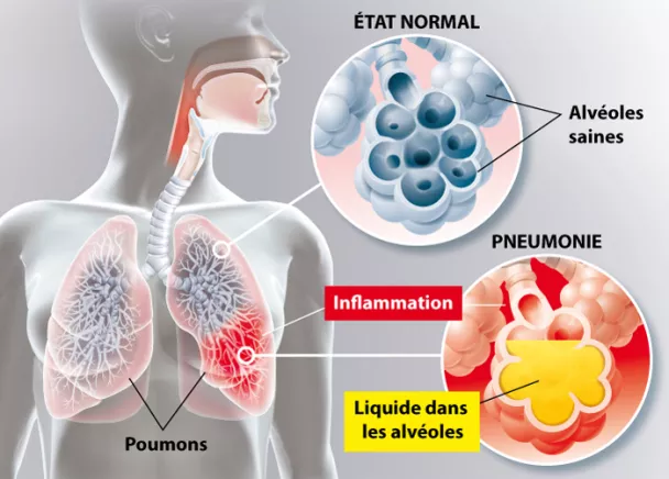 Infection pulmonaire - Infection des poumons | Ramsay Santé