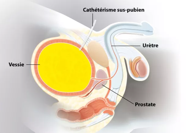 Cathétérisme sus-pubien | Ramsay Santé