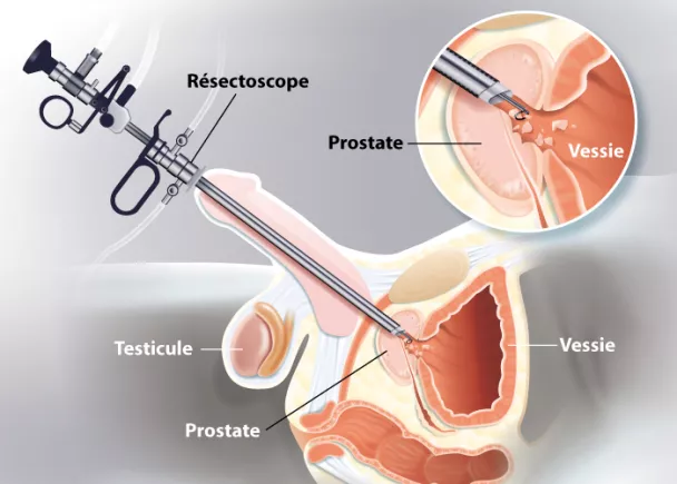 Opération d'un adénome de la prostate par les voies naturelles ...